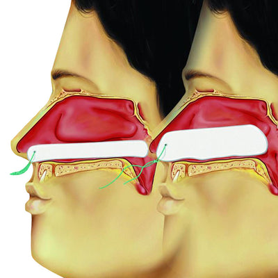 Raucocel Epistaxistamponaden